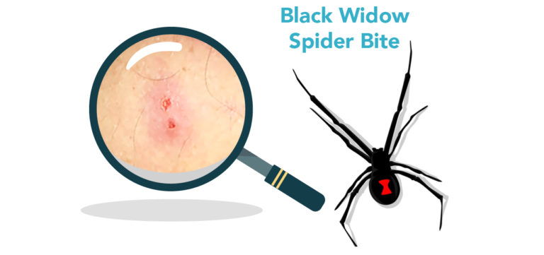 Spider bites: Identification and treatment